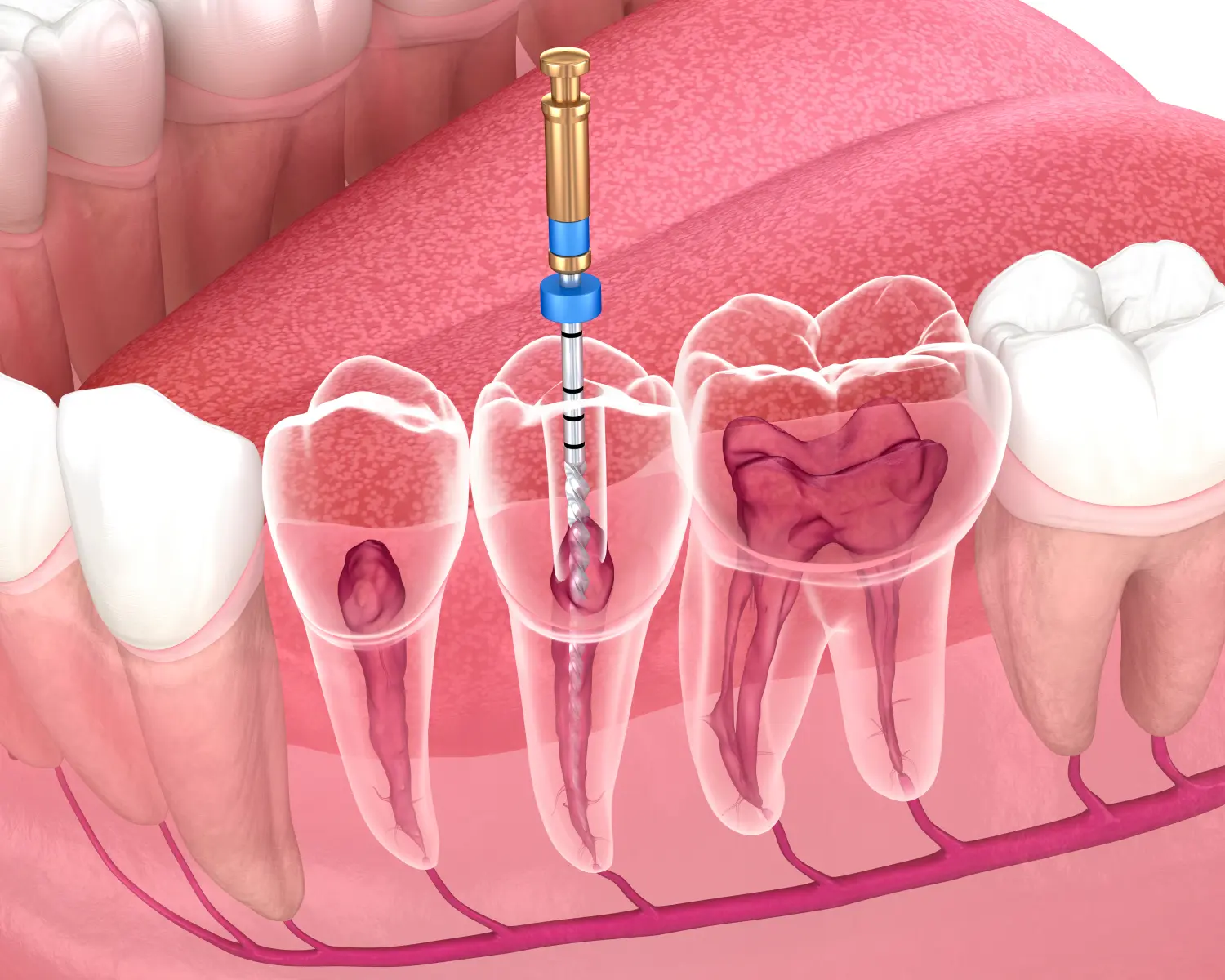 Endodontischer Wurzelkanalbehandlungsprozess. Medizinisch genaue 3D-Zahnillustration.